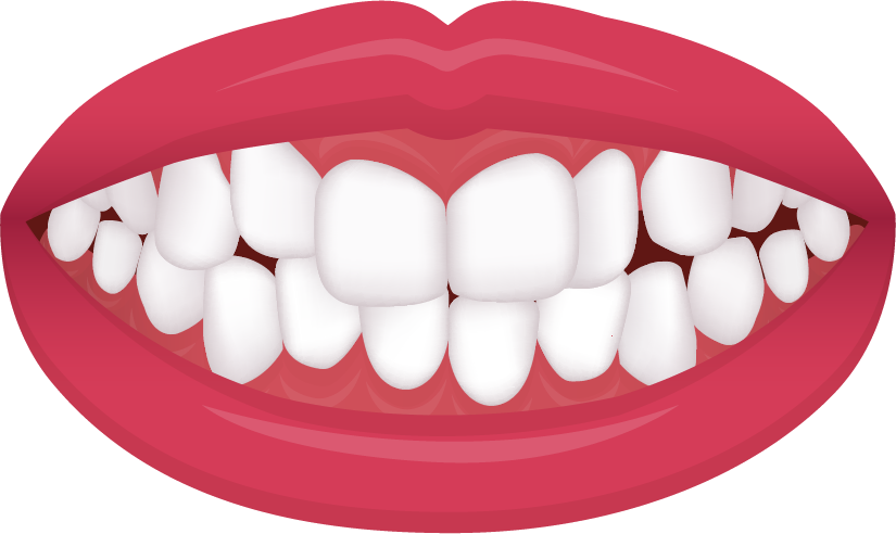 Crowded teeth