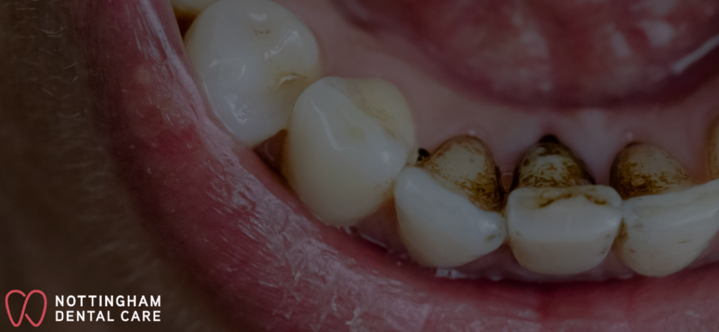 tartar off teeth - how tartar looks like